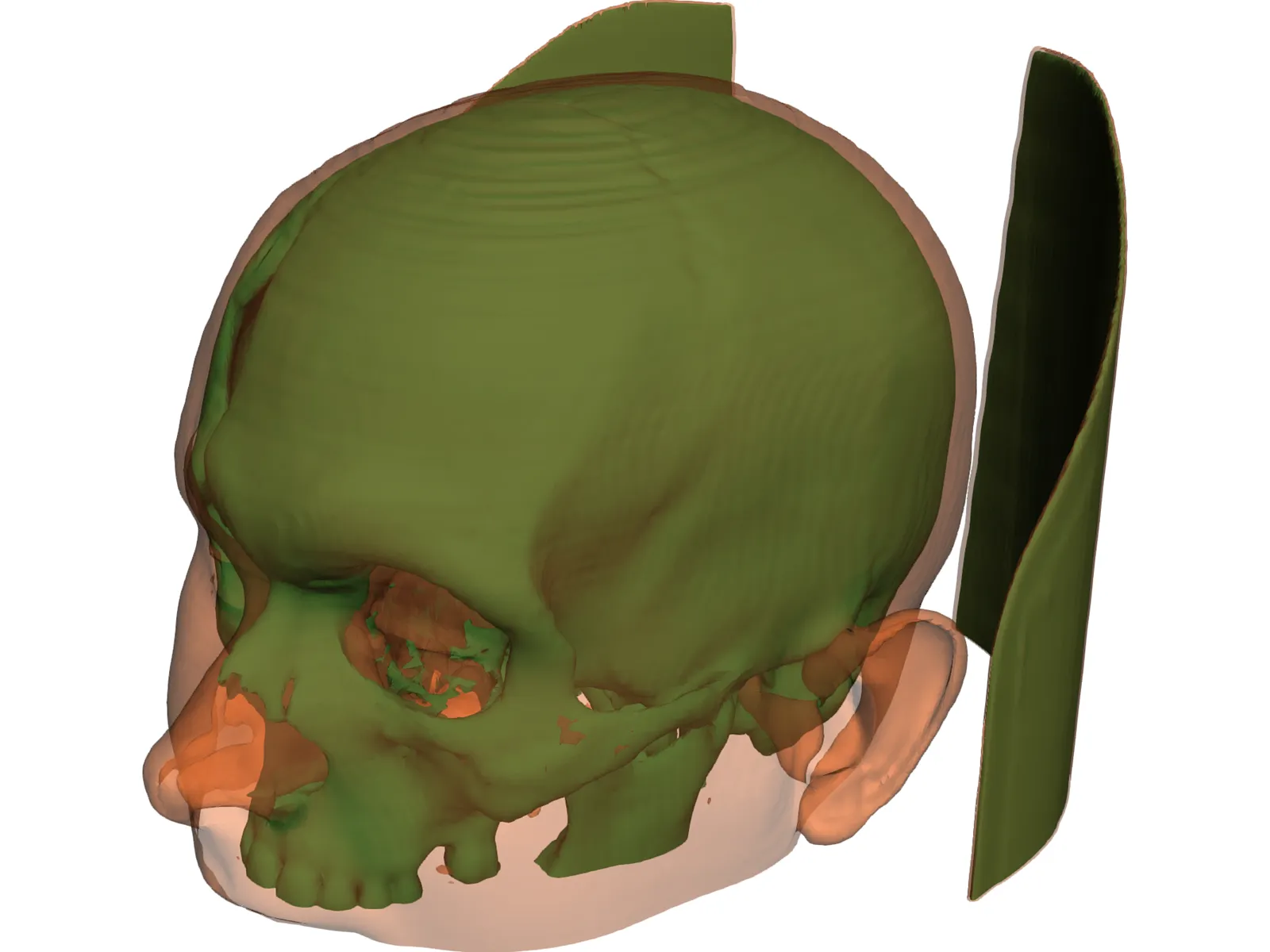 Human Skull InVesalius 3D Model