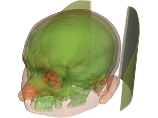 Human Skull InVesalius 3D Model